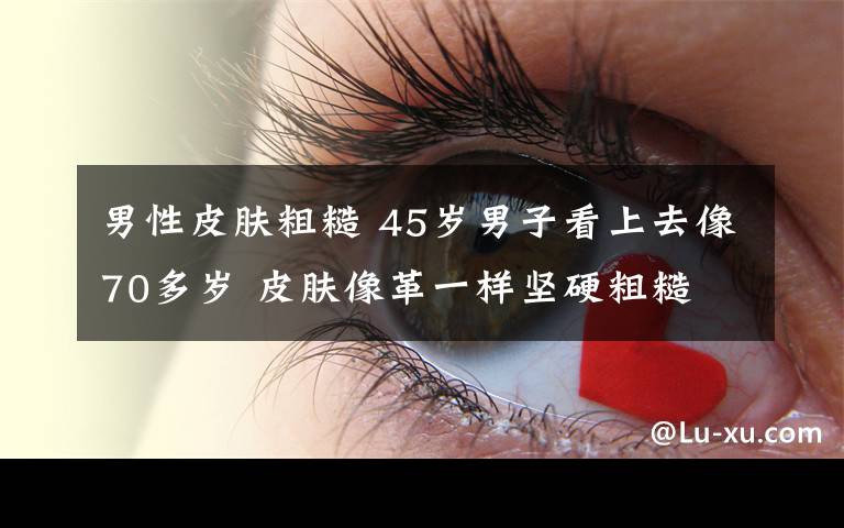 男性皮肤粗糙 45岁男子看上去像70多岁 皮肤像革一样坚硬粗糙