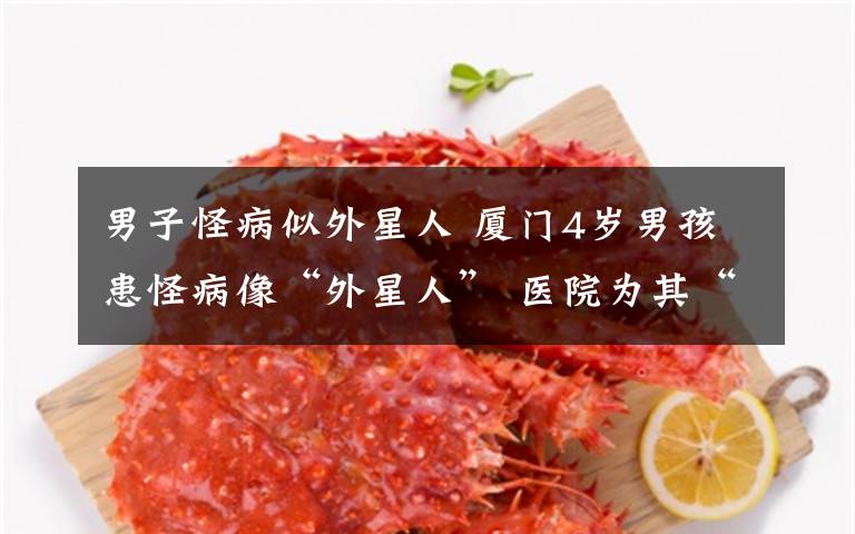 男子怪病似外星人 厦门4岁男孩患怪病像“外星人” 医院为其“改头换面”