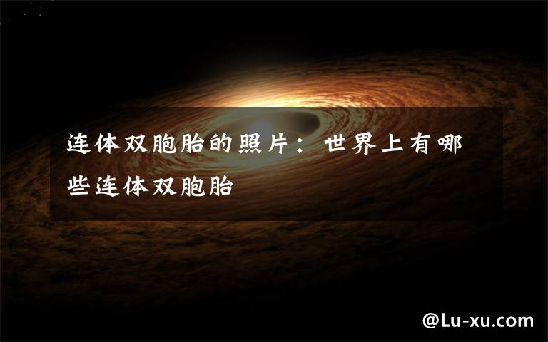 连体双胞胎的照片：世界上有哪些连体双胞胎