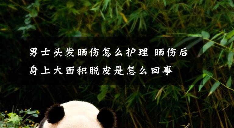 男士头发晒伤怎么护理 晒伤后身上大面积脱皮是怎么回事