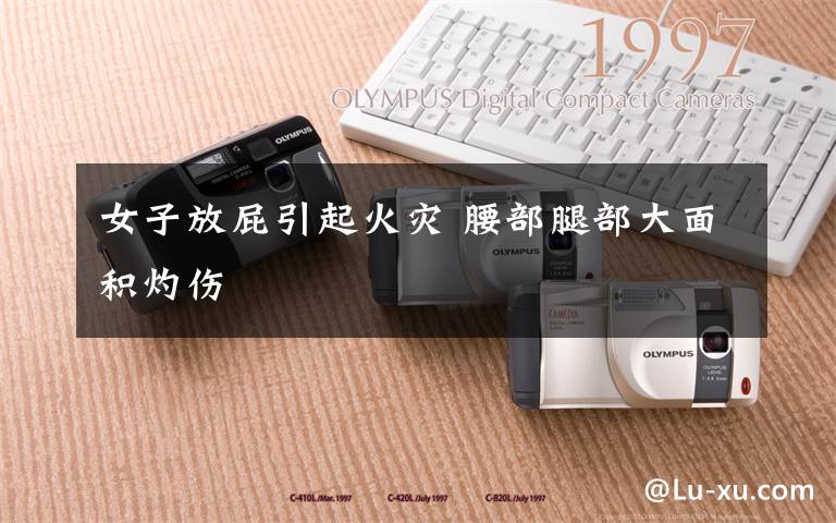 女子放屁引起火灾 腰部腿部大面积灼伤