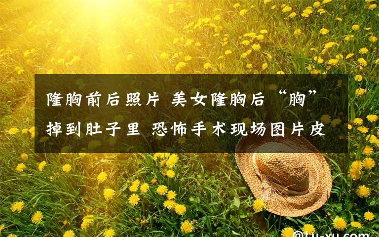 隆胸前后照片 美女隆胸后“胸”掉到肚子里 恐怖手术现场图片皮开肉绽吓死人