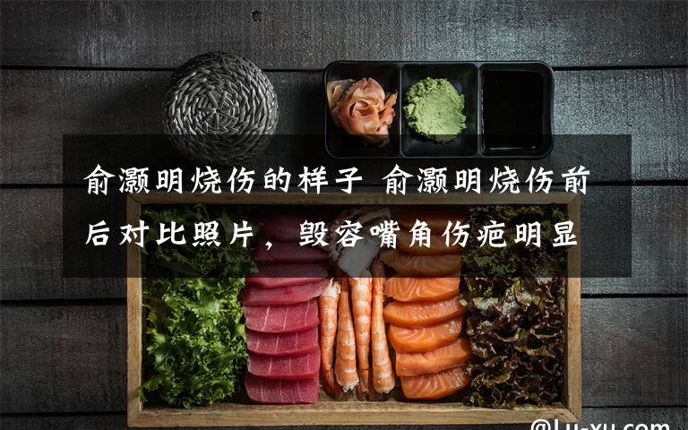 俞灏明烧伤的样子 俞灏明烧伤前后对比照片,毁容嘴角伤疤明显令人揪心