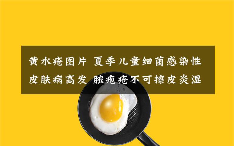 黄水疮图片 夏季儿童细菌感染性皮肤病高发 脓疱疮不可擦皮炎湿疹类药物