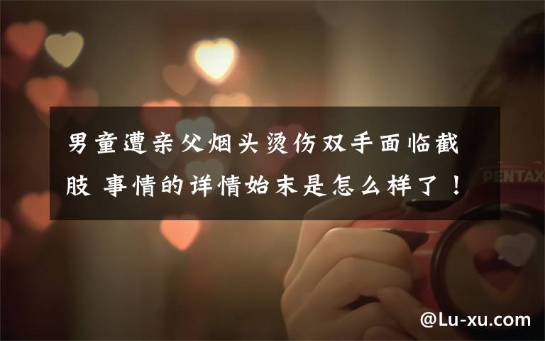 男童遭亲父烟头烫伤双手面临截肢 事情的详情始末是怎么样了!