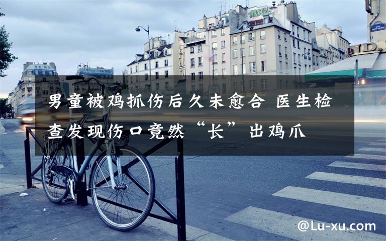 男童被鸡抓伤后久未愈合 医生检查发现伤口竟然“长”出鸡爪