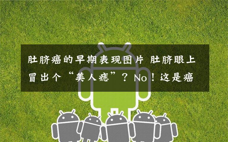 肚脐癌的早期表现图片 肚脐眼上冒出个“美人痣”?No!这是癌症,吓skr!