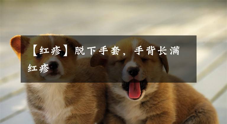 【红疹】脱下手套，手背长满红疹