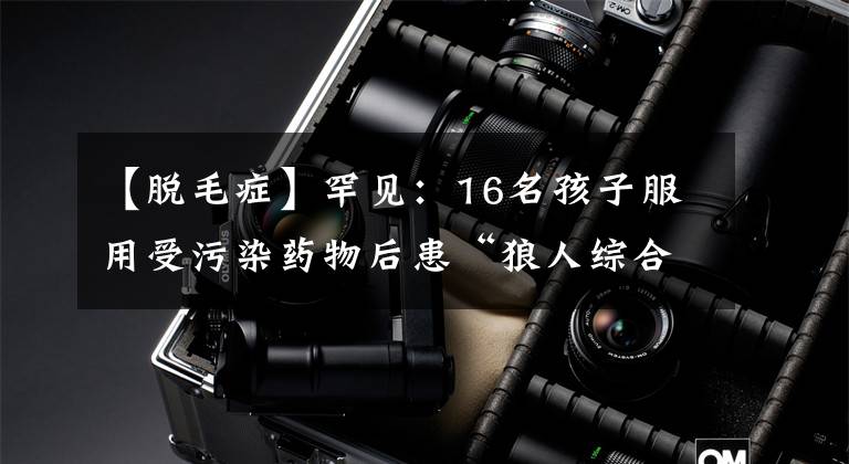 【脱毛症】罕见：16名孩子服用受污染药物后患“狼人综合症”，全身长满毛发
