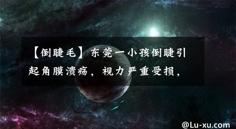 【倒睫毛】东莞一小孩倒睫引起角膜溃疡,视力严重受损,需手术矫正治疗